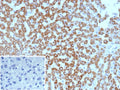 IHC staining of FFPE human hepatocellular carcinoma tissue with CPSase I antibody (clone CPS1/9869). Inset: PBS used in place of primary Ab (secondary Ab negative control). HIER: boil tissue sections in pH 9 10mM Tris with 1mM EDTA for 20 min and allow to cool before testing.