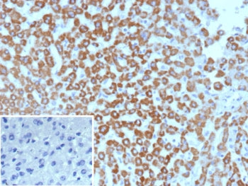 IHC staining of FFPE human hepatocellular carcinoma tissue with CPSase I antibody (clone CPS1/9869). Inset: PBS used in place of primary Ab (secondary Ab negative control). HIER: boil tissue sections in pH 9 10mM Tris with 1mM EDTA for 20 min and allow to cool before testing.