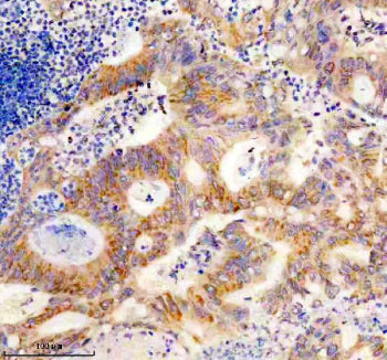 Immunohistochemical staining using SLC25A12 antibody on paraffin-embedded human colon cancer tissue sections. Heat-induced epitope retrieval was performed using EDTA buffer (pH 8.0) prior to antibody incubation. Sections were blocked with 10% goat serum and incubated with SLC25A12 antibody overnight at 4C. Detection was carried out using an HRP-based secondary antibody with DAB as the chromogen. Staining shows cytoplasmic immunoreactivity in tumor cells. Nuclei were counterstained with hematoxylin.