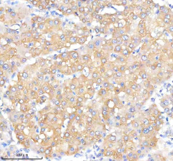 Immunohistochemical staining of IQGAP2 using anti-IQGAP2 antibody. IQGAP2 was detected in a paraffin-embedded section of human liver cancer tissue. Heat mediated antigen retrieval was performed in EDTA buffer (pH 8.0, epitope retrieval solution). The tissue section was blocked with 10% goat serum. The tissue section was then incubated with 1:50 rabbit anti-IQGAP2 antibody overnight at 4oC. Peroxidase Conjugated Goat Anti-rabbit IgG was used as secondary antibody and incubated for 30 min at 37oC.