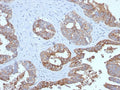 IHC testing of FFPE human prostate carcinoma with recombinant MUC1 antibody. Required HIER: boil tissue sections in pH 9 10mM Tris with 1mM EDTA for 10-20 min followed by cooling at RT for 20 min.