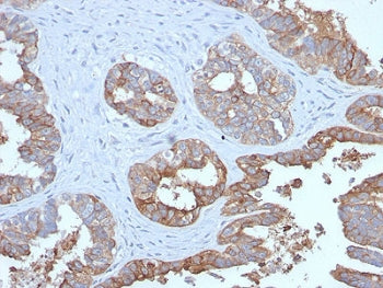 IHC testing of FFPE human prostate carcinoma with recombinant MUC1 antibody. Required HIER: boil tissue sections in pH 9 10mM Tris with 1mM EDTA for 10-20 min followed by cooling at RT for 20 min.