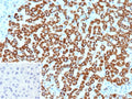 IHC staining of FFPE human hepatocellular carcinoma tissue with Carbamoyl phosphate synthetase 1 antibody (clone CPS1/9867). Inset: PBS used in place of primary Ab (secondary Ab negative control). HIER: boil tissue sections in pH 9 10mM Tris with 1mM EDTA for 20 min and allow to cool before testing.