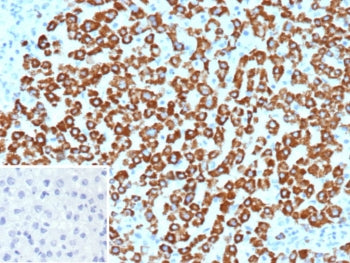 IHC staining of FFPE human hepatocellular carcinoma tissue with Carbamoyl phosphate synthetase 1 antibody (clone CPS1/9867). Inset: PBS used in place of primary Ab (secondary Ab negative control). HIER: boil tissue sections in pH 9 10mM Tris with 1mM EDTA for 20 min and allow to cool before testing.