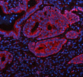 Immunofluorescent staining of FFPE human colon cancer tissue with SHMT2 antibody (red) and DAPI nuclear stain (blue). HIER: steam section in pH8 EDTA buffer for 20 min.