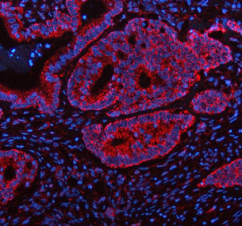 Immunofluorescent staining of FFPE human colon cancer tissue with SHMT2 antibody (red) and DAPI nuclear stain (blue). HIER: steam section in pH8 EDTA buffer for 20 min.