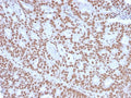 IHC staining of FFPE human endometrial carcinoma with Progesterone Receptor antibody (clone PGR/2694). HIER: boil tissue sections in pH6, 10mM citrate buffer, for 10-20 min and allow to cool before testing.