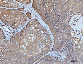 IHC staining of FFPE human laryngeal squamous cell carcinoma tissue with YWHAE antibody. HIER: boil tissue sections in pH8 EDTA for 20 min and allow to cool before testing.