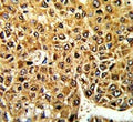 IHC testing of FFPE human hepatocellular carcinoma tissue with Max-like protein X antibody. HIER: steam section in pH6 citrate buffer for 20 min and allow to cool prior to staining.