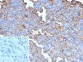 IHC staining of FFPE human melanoma tissue with recombinant BRAF V600E antibody (clone BRAF-V600E/13276R). Inset: PBS used in place of primary Ab (secondary Ab negative control). HIER: boil tissue sections in pH 9 10mM Tris with 1mM EDTA for 20 min and allow to cool before testing.
