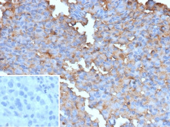 IHC staining of FFPE human melanoma tissue with recombinant BRAF V600E antibody (clone BRAF-V600E/13276R). Inset: PBS used in place of primary Ab (secondary Ab negative control). HIER: boil tissue sections in pH 9 10mM Tris with 1mM EDTA for 20 min and allow to cool before testing.