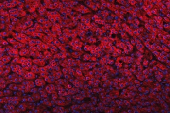 Immunofluorescent staining of FFPE human liver cancer tissue with Delta-5 desaturase antibody (red) and DAPI nuclear stain (blue). HIER: steam section in pH8 EDTA buffer for 20 min.