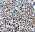 Immunohistochemical staining of TIMM50 using anti-TIMM50 antibody. TIMM50 was detected in a paraffin-embedded section of human liver cancer tissue. Heat mediated antigen retrieval was performed in EDTA buffer (pH 8.0, epitope retrieval solution). The tissue section was blocked with 10% goat serum. The tissue section was then incubated with 2 ug/ml rabbit anti-TIMM50 antibody overnight at 4oC. Peroxidase Conjugated Goat Anti-rabbit IgG was used as secondary antibody and incubated for 30 min at 37oC.