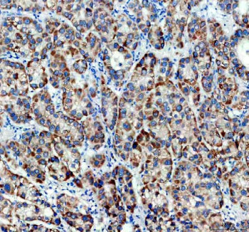 Immunohistochemical staining of TIMM50 using anti-TIMM50 antibody. TIMM50 was detected in a paraffin-embedded section of human liver cancer tissue. Heat mediated antigen retrieval was performed in EDTA buffer (pH 8.0, epitope retrieval solution). The tissue section was blocked with 10% goat serum. The tissue section was then incubated with 2 ug/ml rabbit anti-TIMM50 antibody overnight at 4oC. Peroxidase Conjugated Goat Anti-rabbit IgG was used as secondary antibody and incubated for 30 min at 37oC.