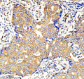 IHC analysis of AMPD1 using anti-AMPD1 antibody. AMPD1 was detected in a paraffin-embedded section of human breast cancer tissue. Heat mediated antigen retrieval was performed in EDTA buffer (pH 8.0, epitope retrieval solution). The tissue section was blocked with 10% goat serum. The tissue section was then incubated with 2 ug/ml rabbit anti-AMPD1 antibody overnight at 4oC. Peroxidase Conjugated Goat Anti-rabbit IgG was used as secondary antibody and incubated for 30 min at 37oC.