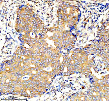 IHC analysis of AMPD1 using anti-AMPD1 antibody. AMPD1 was detected in a paraffin-embedded section of human breast cancer tissue. Heat mediated antigen retrieval was performed in EDTA buffer (pH 8.0, epitope retrieval solution). The tissue section was blocked with 10% goat serum. The tissue section was then incubated with 2 ug/ml rabbit anti-AMPD1 antibody overnight at 4oC. Peroxidase Conjugated Goat Anti-rabbit IgG was used as secondary antibody and incubated for 30 min at 37oC.