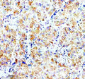 Immunohistochemical staining of OPN5 using anti-OPN5 antibody. OPN5 was detected in a paraffin-embedded section of human liver cancer tissue. Heat mediated antigen retrieval was performed in EDTA buffer (pH 8.0, epitope retrieval solution). The tissue section was blocked with 10% goat serum. The tissue section was then incubated with 2 ug/ml rabbit anti-OPN5 antibody overnight at 4oC. Peroxidase Conjugated Goat Anti-rabbit IgG was used as secondary antibody and incubated for 30 min at 37oC.