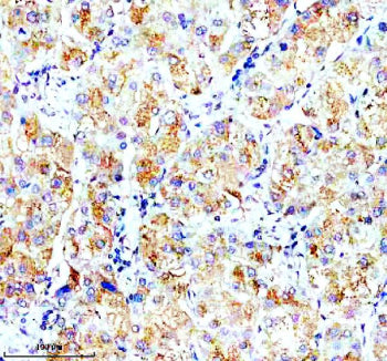 Immunohistochemical staining of OPN5 using anti-OPN5 antibody. OPN5 was detected in a paraffin-embedded section of human liver cancer tissue. Heat mediated antigen retrieval was performed in EDTA buffer (pH 8.0, epitope retrieval solution). The tissue section was blocked with 10% goat serum. The tissue section was then incubated with 2 ug/ml rabbit anti-OPN5 antibody overnight at 4oC. Peroxidase Conjugated Goat Anti-rabbit IgG was used as secondary antibody and incubated for 30 min at 37oC.