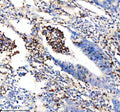 Immunohistochemical staining of Granzyme M/GZMM using anti-GZMM antibody. Granzyme M/GZMM was detected in a paraffin-embedded section of human breast cancer tissue. Heat mediated antigen retrieval was performed in EDTA buffer (pH 8.0, epitope retrieval solution). The tissue section was blocked with 10% goat serum. The tissue section was then incubated with 2 ug/ml rabbit anti-GZMM antibody overnight at 4oC.