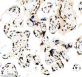 IHC analysis of Histone H3 (acetyl K14) using anti-Histone H3 (acetyl K14) antibody. Histone H3 (acetyl K14) was detected in a paraffin-embedded section of human clear cell renal cell carcinoma tissue. Heat mediated antigen retrieval was performed in EDTA buffer (pH 8.0, epitope retrieval solution). The tissue section was blocked with 10% goat serum. The tissue section was then incubated with a dilution of 1:50 rabbit anti-Histone H3 (acetyl K14) antibody overnight at 4oC.