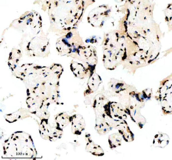 IHC analysis of Histone H3 (acetyl K14) using anti-Histone H3 (acetyl K14) antibody. Histone H3 (acetyl K14) was detected in a paraffin-embedded section of human clear cell renal cell carcinoma tissue. Heat mediated antigen retrieval was performed in EDTA buffer (pH 8.0, epitope retrieval solution). The tissue section was blocked with 10% goat serum. The tissue section was then incubated with a dilution of 1:50 rabbit anti-Histone H3 (acetyl K14) antibody overnight at 4oC.
