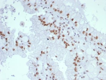 IHC staining of FFPE human renal cell carcinoma tissue with MutL Homolog 1 antibody (clone MLH1/7560). HIER: boil tissue sections in pH 9 10mM Tris with 1mM EDTA for 20 min and allow to cool before testing.