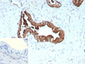 IHC staining of FFPE human prostate cancer tissue with recombinant KRT19 antibody (clone rKRT19/9108). Inset: PBS used in place of primary Ab (secondary Ab negative control). HIER: boil tissue sections in pH 9 10mM Tris with 1mM EDTA for 20 min and allow to cool before testing.
