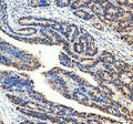 Immunohistochemical staining of DNMT3A using anti-DNMT3A antibody. DNMT3A was detected in a paraffin-embedded section of human colon cancer tissue. Heat mediated antigen retrieval was performed in EDTA buffer (pH 8.0, epitope retrieval solution). The tissue section was blocked with 10% goat serum. The tissue section was then incubated with 2 ug/ml rabbit anti-DNMT3A antibody overnight at 4oC. Peroxidase Conjugated Goat Anti-rabbit IgG was used as secondary antibody and incubated for 30 minutes at 37oC. The