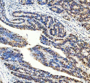 Immunohistochemical staining of DNMT3A using anti-DNMT3A antibody. DNMT3A was detected in a paraffin-embedded section of human colon cancer tissue. Heat mediated antigen retrieval was performed in EDTA buffer (pH 8.0, epitope retrieval solution). The tissue section was blocked with 10% goat serum. The tissue section was then incubated with 2 ug/ml rabbit anti-DNMT3A antibody overnight at 4oC. Peroxidase Conjugated Goat Anti-rabbit IgG was used as secondary antibody and incubated for 30 minutes at 37oC. The