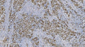 IHC staining of FFPE human gastric cancer tissue with Aryl hydrocarbon Receptor antibody. HIER: boil tissue sections in pH8 EDTA for 20 min and allow to cool before testing.