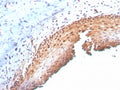 IHC staining of FFPE human cervix with p16INK4a antibody (clone CDKN2A/3830). HIER: boil tissue sections in pH 9 10mM Tris with 1mM EDTA for 20 min and allow to cool before testing.