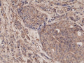 IHC testing of FFPE human breast cancer tissue with recombinant p65 antibody at 1:1250.