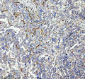 IHC analysis of GIMAP4 using anti-GIMAP4 antibody. GIMAP4 was detected in a paraffin-embedded section of human ovarian cancer tissue. Heat mediated antigen retrieval was performed in EDTA buffer (pH 8.0, epitope retrieval solution). The tissue section was blocked with 10% goat serum. The tissue section was then incubated with 2 ug/ml rabbit anti-GIMAP4 antibody overnight at 4oC. Peroxidase Conjugated Goat Anti-rabbit IgG was used as secondary antibody and incubated for 30 min at 37oC.