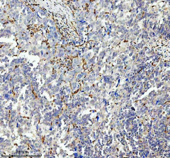 IHC analysis of GIMAP4 using anti-GIMAP4 antibody. GIMAP4 was detected in a paraffin-embedded section of human ovarian cancer tissue. Heat mediated antigen retrieval was performed in EDTA buffer (pH 8.0, epitope retrieval solution). The tissue section was blocked with 10% goat serum. The tissue section was then incubated with 2 ug/ml rabbit anti-GIMAP4 antibody overnight at 4oC. Peroxidase Conjugated Goat Anti-rabbit IgG was used as secondary antibody and incubated for 30 min at 37oC.