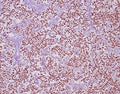 IHC staining of FFPE human seminoma tissue with OCT4 antibody (clone OCT4/6847R) at 2ug/ml. HIER: boil tissue sections in pH 9 10mM Tris with 1mM EDTA for 20 min and allow to cool before testing.