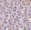 IHC staining of FFPE human thyroid papillary carcinoma tissue with NEIL3 antibody. HIER: boil tissue sections in pH8 EDTA for 20 min and allow to cool before testing.