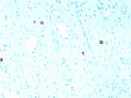 IHC staining of FFPE human cervix with recombinant HPV16 L1 antibody (clone rHPV16L1/1058). Required HIER: boil tissue sections in pH6, 10mM citrate buffer, for 10-20 min followed by cooling at RT for 20 min.