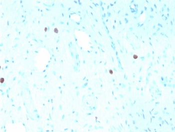IHC staining of FFPE human cervix with recombinant HPV16 L1 antibody (clone rHPV16L1/1058). Required HIER: boil tissue sections in pH6, 10mM citrate buffer, for 10-20 min followed by cooling at RT for 20 min.