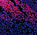 Immunofluorescent staining of TNFAIP2 using anti-TNFAIP2 antibody (red). TNFAIP2 was detected in a paraffin-embedded section of human bladder cancer tissue. Heat mediated antigen retrieval was performed in EDTA buffer (pH 8.0, epitope retrieval solution). The tissue section was blocked with 10% goat serum. The tissue section was then incubated with 5 ug/ml rabbit anti-TNFAIP2 antibody overnight at 4oC.