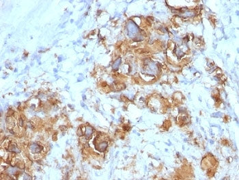 IHC: Formalin-fixed, paraffin-embedded human gastric carcinoma stained with CA19-9 antibody (121SLE).