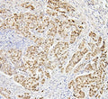 IHC staining of FFPE human breast cancer with Histone H1.0 antibody. HIER: boil tissue sections in pH6, 10mM citrate buffer, for 20 min and allow to cool before testing.
