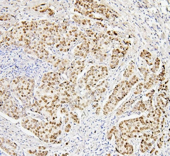 IHC staining of FFPE human breast cancer with Histone H1.0 antibody. HIER: boil tissue sections in pH6, 10mM citrate buffer, for 20 min and allow to cool before testing.