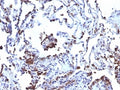 IHC: Formalin-fixed, paraffin-embedded human melanoma metastasized to lung stained with CD63 antibody (NKI/C3 + LAMP3/968)