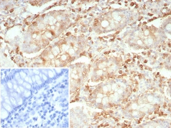 IHC staining of FFPE human colon carcinoma tissue with recombinant STMN1 antibody (clone rSTMN1/9255). Inset: PBS used in place of primary Ab (secondary Ab negative control). HIER: boil tissue sections in pH 9 10mM Tris with 1mM EDTA for 20 min and allow to cool before testing.