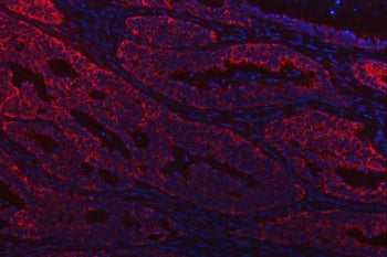 Immunofluorescent staining of FFPE human lung cancer tissue with Thiosulfate sulfurtransferase antibody (red) and DAPI nuclear stain (blue). HIER: steam section in pH8 EDTA buffer for 20 min.