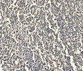 IHC staining of FFPE human pancreatic cancer with ATG9A antibody. HIER: boil tissue sections in pH8 EDTA for 20 min and allow to cool before testing.