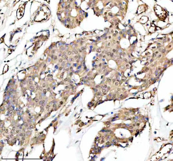 Immunohistochemical staining of PUF60 using anti-PUF60 antibody. PUF60 was detected in a paraffin-embedded section of human breast cancer tissue. Heat mediated antigen retrieval was performed in EDTA buffer (pH 8.0, epitope retrieval solution). The tissue section was blocked with 10% goat serum. The tissue section was then incubated with 2 ug/ml rabbit anti-PUF60 antibody overnight at 4oC. Peroxidase Conjugated Goat Anti-rabbit IgG was used as secondary antibody and incubated for 30 min at 37oC.