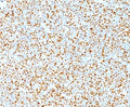 IHC testing of human mantle cell lymphoma stained with Cyclin D1 antibody. Nuclear staining of tumor cells is seen.