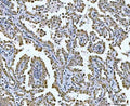 IHC staining of FFPE human lung cancer tissue with GLIS1 antibody. HIER: boil tissue sections in pH8 EDTA for 20 min and allow to cool before testing.