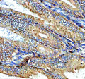 Immunohistochemical staining of NTN4 using anti-NTN4 antibody. NTN4 was detected in a paraffin-embedded section of human endometrial cancer tissue. Heat mediated antigen retrieval was performed in EDTA buffer (pH 8.0, epitope retrieval solution). The tissue section was blocked with 10% goat serum. The tissue section was then incubated with 2 ug/ml rabbit anti-NTN4 antibody overnight at 4oC. Peroxidase Conjugated Goat Anti-rabbit IgG was used as secondary antibody and incubated for 30 min at 37oC.